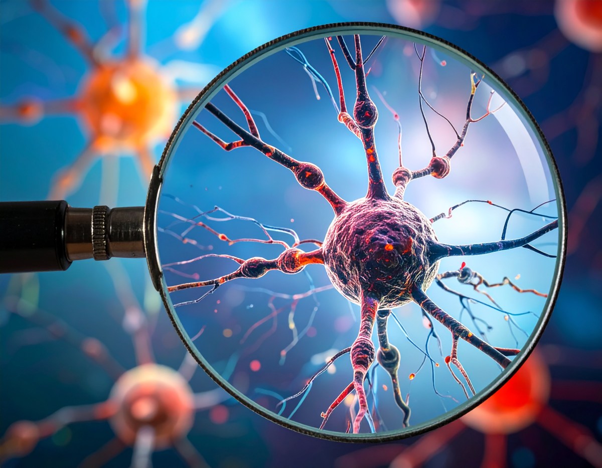 Understanding Parkinson’s Disease Through the Lens of Aging – Part 2